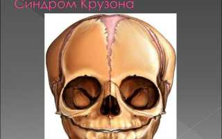Синдром крузона из за чего