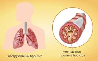 Хронический бронхит с бронхообструктивным синдромом лечение