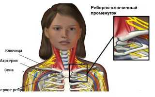 Для синдрома лестничной мышцы характерны