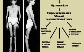 Доклад на тему синдром марфана