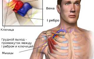 Операции при синдроме грудного выхода