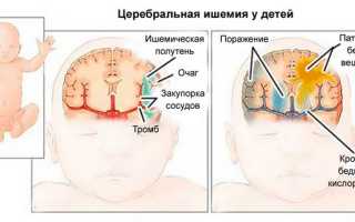 Что такое церебральная ишемия синдром возбуждения