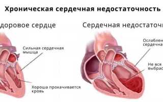 Сердечная недостаточность код по мкб 10 у детей