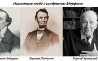 Синдром марфана у новорожденных фото