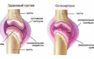 Деформирующий остеоартрозе болевой синдром связан с