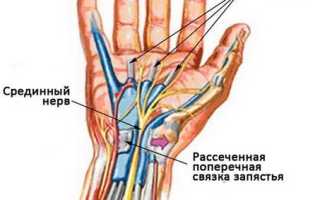 Цена операции при карпальном синдроме