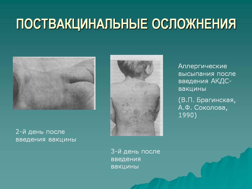 Местная реакция на прививку код мкб