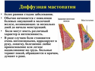 Мастит у кормящей матери код мкб