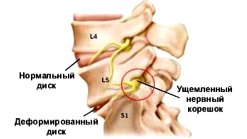 Остеохондроз поясничного отдела с корешковым синдромом симптомы лечение