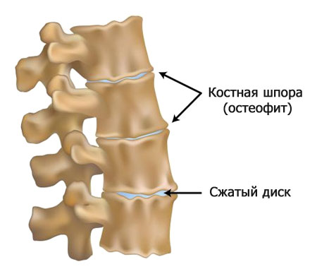 позвонки с остеофитами