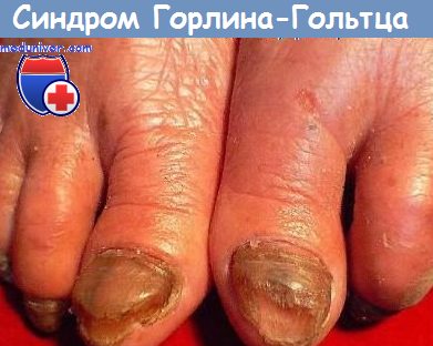 синдром Горлина-Гольтца