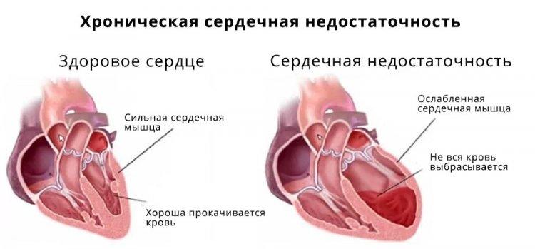 Хроническая сердечная недостаточность