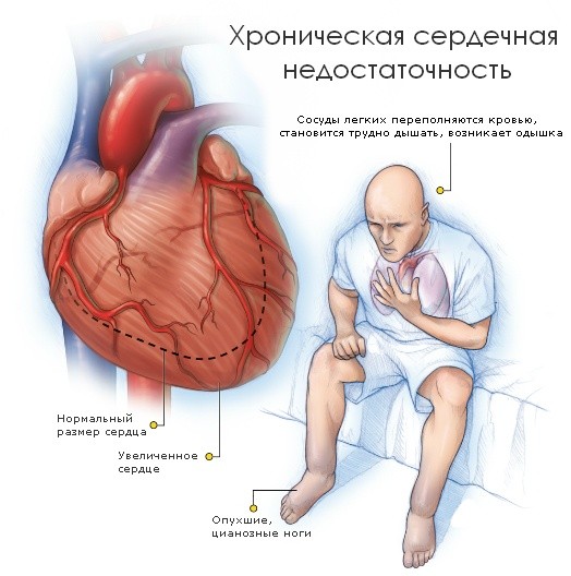 Хроническая сердечная недостаточность