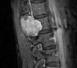 Экстрамедуллярные опухоли спинного мозга