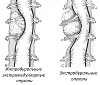 Экстрамедуллярные опухоли спинного мозга