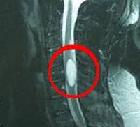 Интрамедуллярные опухоли спинного мозга