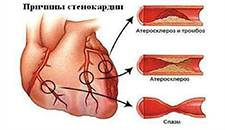 Симптомы и синдромы при стенокардии