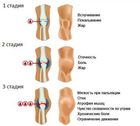 Код мкб закрытый перелом надколенника