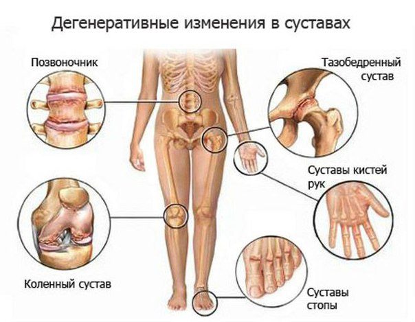 Дегенеративные изменения в суставах