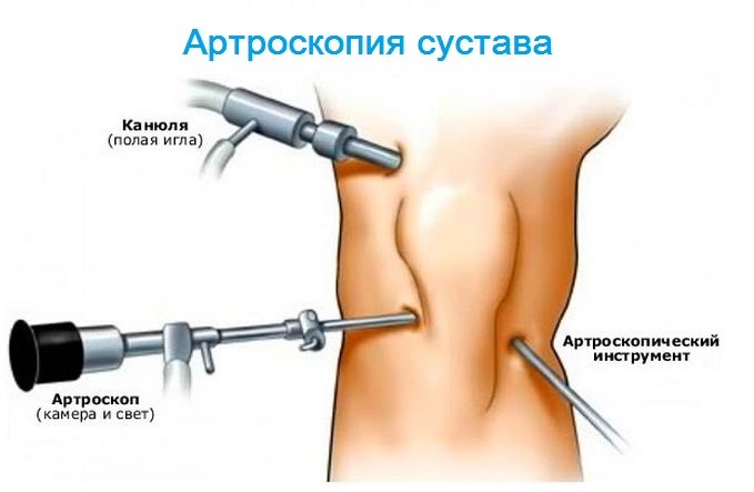 Артроскопия колена