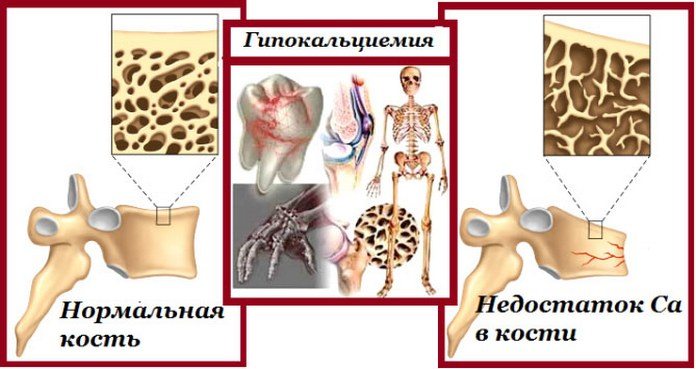 Недостаток кальция в организме