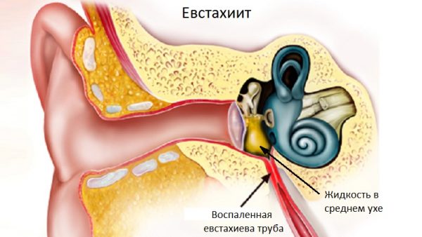 Как проявляется турбоотит