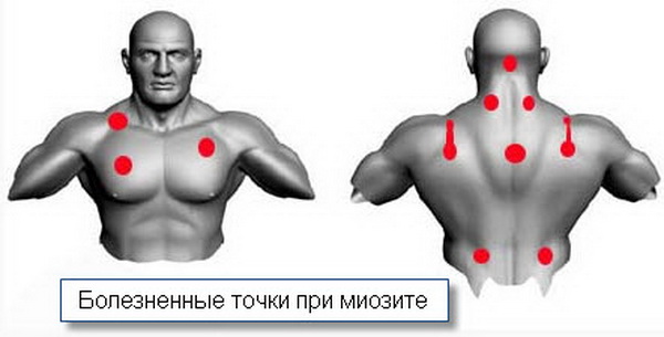 Места локализации болезненных точек при миозите