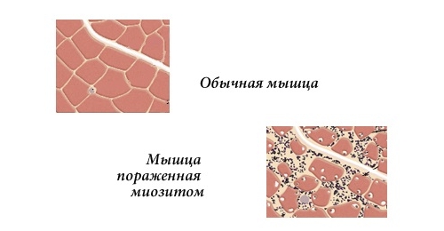 Так выглядит мышца пораженная миозитом