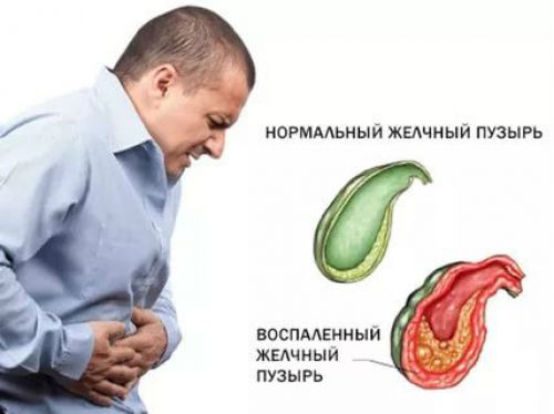 Воспаленный желчный пузырь