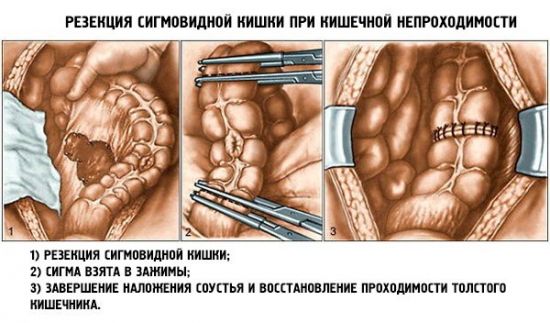 Резекция сигмовидной кишки