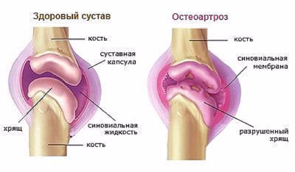 f7418389e26cb367a019108add5703fd1 300x175 - Деформирующий остеоартроз суставов - симптомы, лечение