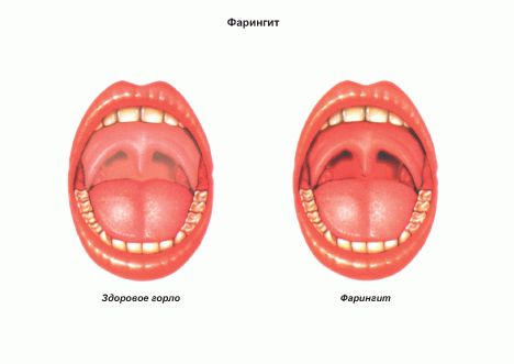 Гиперемия зева при фарингите
