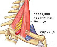 Синдром лестничной мышцы