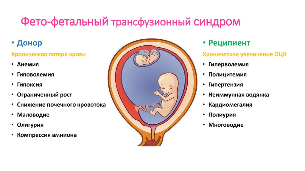 Последствия синдрома фето-фетальной трансфузии у близнецов