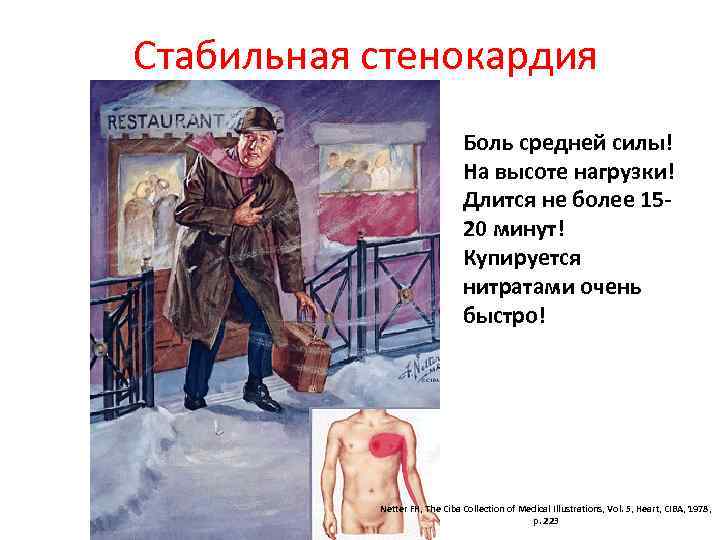 Стабильная стенокардия Боль средней силы! На высоте нагрузки! Длится не более 1520 минут! Купируется Стабильная стенокардия Боль средней силы! На высоте нагрузки! Длится не более 1520 минут! Купируется