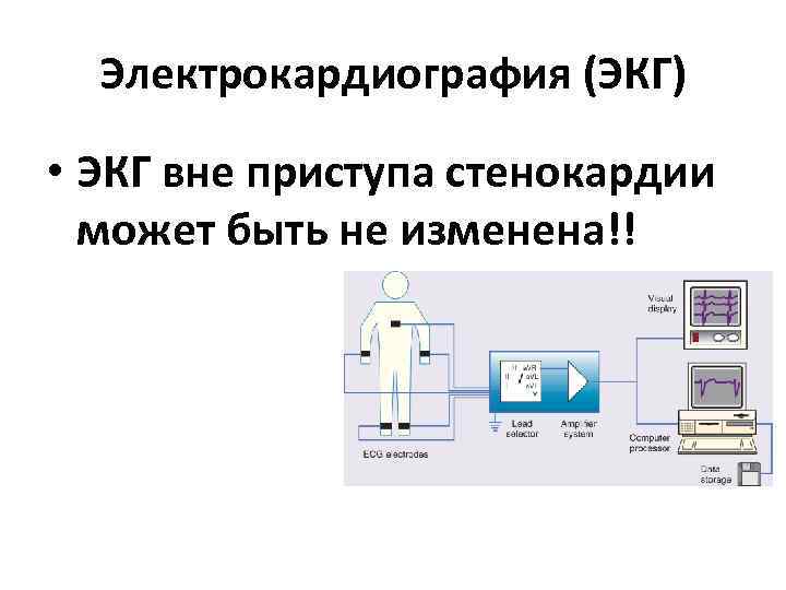 Электрокардиография (ЭКГ) • ЭКГ вне приступа стенокардии может быть не изменена!! Электрокардиография (ЭКГ) • ЭКГ вне приступа стенокардии может быть не изменена!!