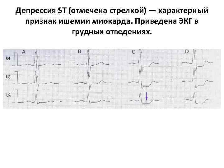 Депрессия ST (отмечена стрелкой) — характерный признак ишемии миокарда. Приведена ЭКГ в грудных отведениях. Депрессия ST (отмечена стрелкой) — характерный признак ишемии миокарда. Приведена ЭКГ в грудных отведениях.