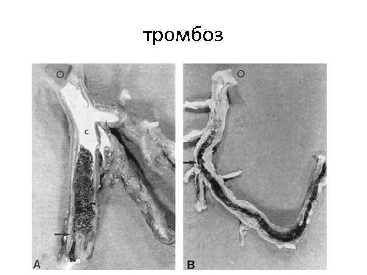 тромбоз тромбоз