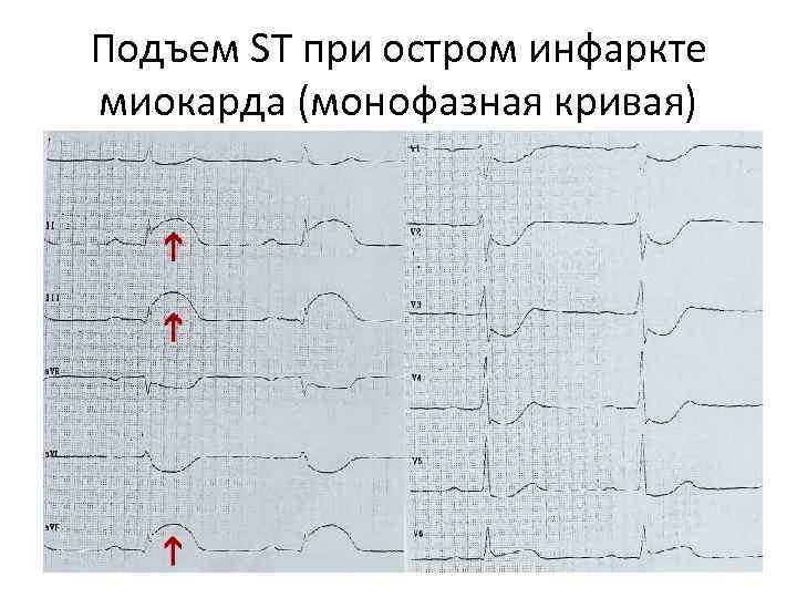 Подъем ST при остром инфаркте миокарда (монофазная кривая) Подъем ST при остром инфаркте миокарда (монофазная кривая)