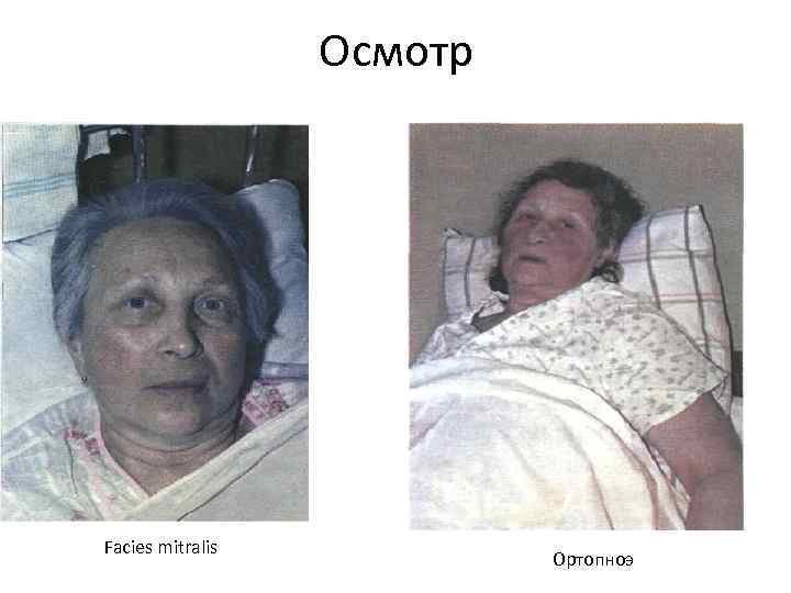 Осмотр Facies mitralis Ортопноэ Осмотр Facies mitralis Ортопноэ