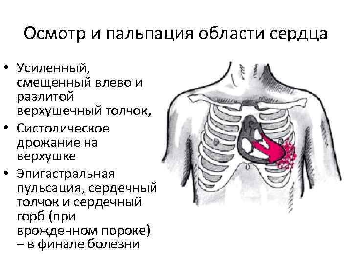 Осмотр и пальпация области сердца • Усиленный, смещенный влево и разлитой верхушечный толчок, • Осмотр и пальпация области сердца • Усиленный, смещенный влево и разлитой верхушечный толчок, •