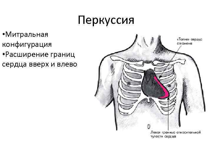Перкуссия • Митральная конфигурация • Расширение границ сердца вверх и влево Перкуссия • Митральная конфигурация • Расширение границ сердца вверх и влево