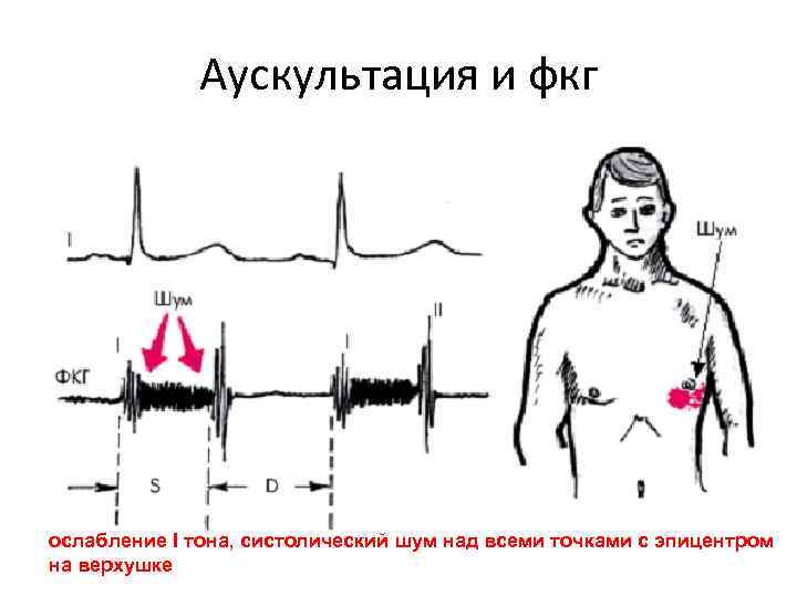 Аускультация и фкг ослабление I тона, систолический шум над всеми точками с эпицентром на Аускультация и фкг ослабление I тона, систолический шум над всеми точками с эпицентром на