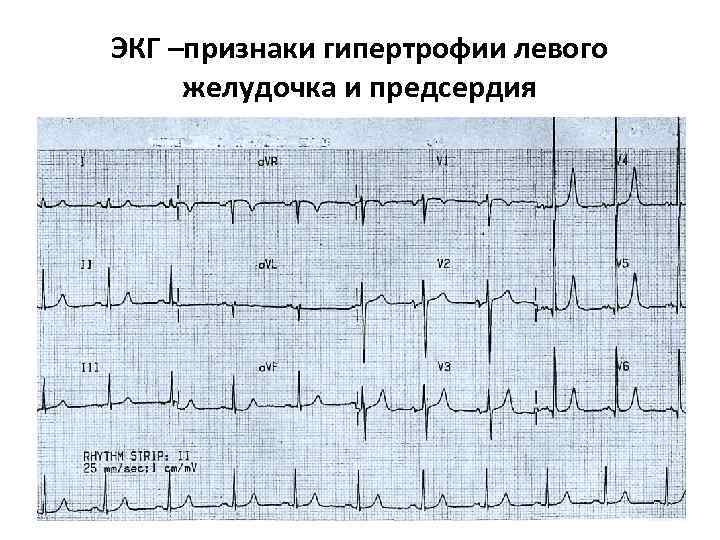 ЭКГ –признаки гипертрофии левого желудочка и предсердия ЭКГ –признаки гипертрофии левого желудочка и предсердия