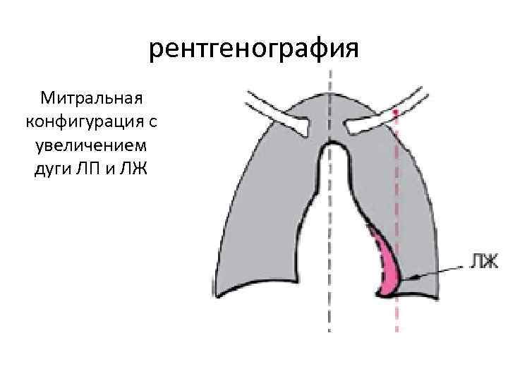 рентгенография Митральная конфигурация с увеличением дуги ЛП и ЛЖ рентгенография Митральная конфигурация с увеличением дуги ЛП и ЛЖ