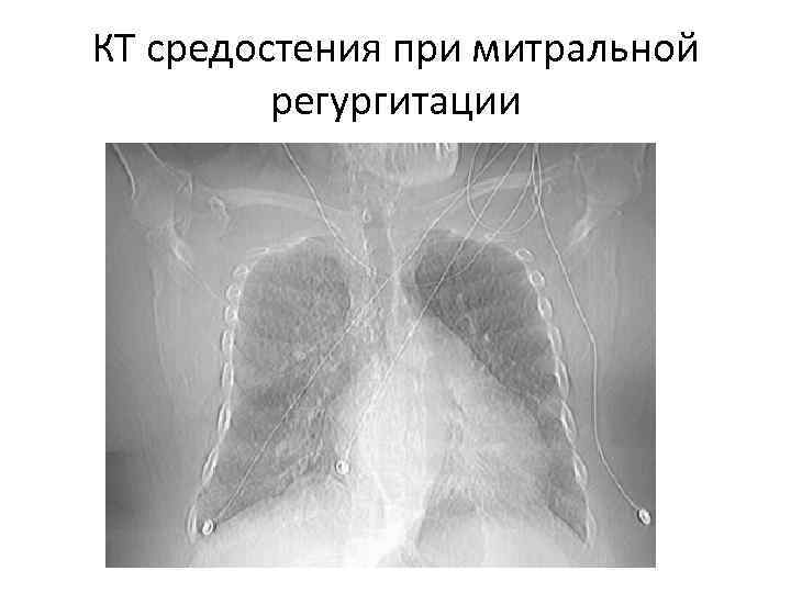 КТ средостения при митральной регургитации КТ средостения при митральной регургитации