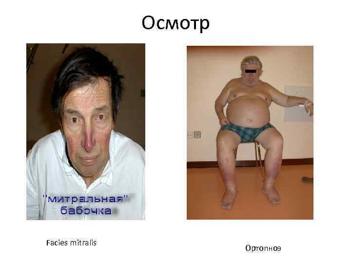 Осмотр Facies mitralis Ортопноэ Осмотр Facies mitralis Ортопноэ