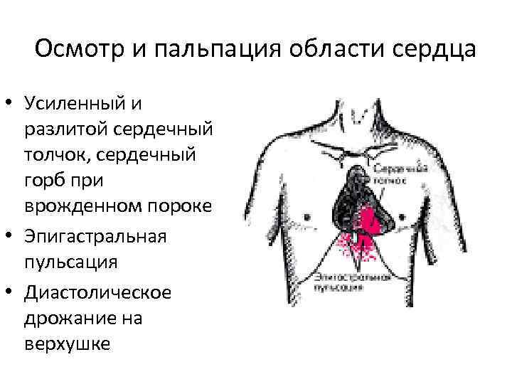Осмотр и пальпация области сердца • Усиленный и разлитой сердечный толчок, сердечный горб при Осмотр и пальпация области сердца • Усиленный и разлитой сердечный толчок, сердечный горб при