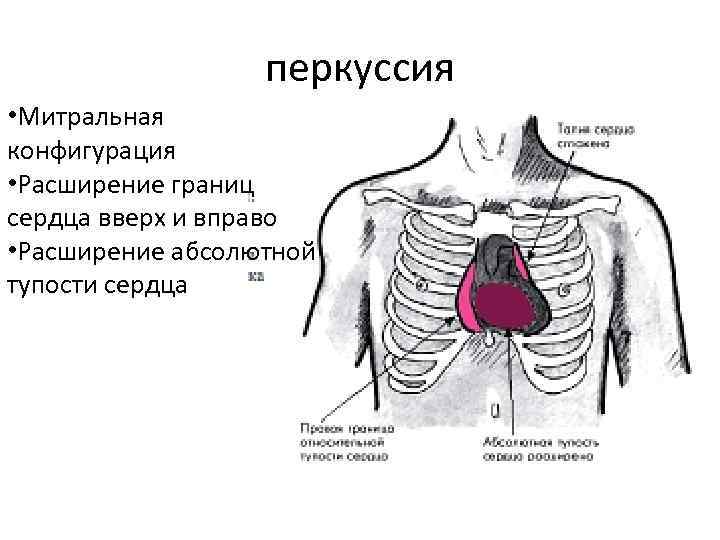 перкуссия • Митральная конфигурация • Расширение границ сердца вверх и вправо • Расширение абсолютной перкуссия • Митральная конфигурация • Расширение границ сердца вверх и вправо • Расширение абсолютной