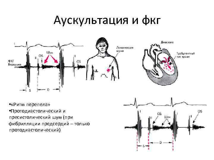 Аускультация и фкг • «Ритм перепела» • Протодиастолический и пресистолический шум (при фибрилляции предсердий Аускультация и фкг • «Ритм перепела» • Протодиастолический и пресистолический шум (при фибрилляции предсердий
